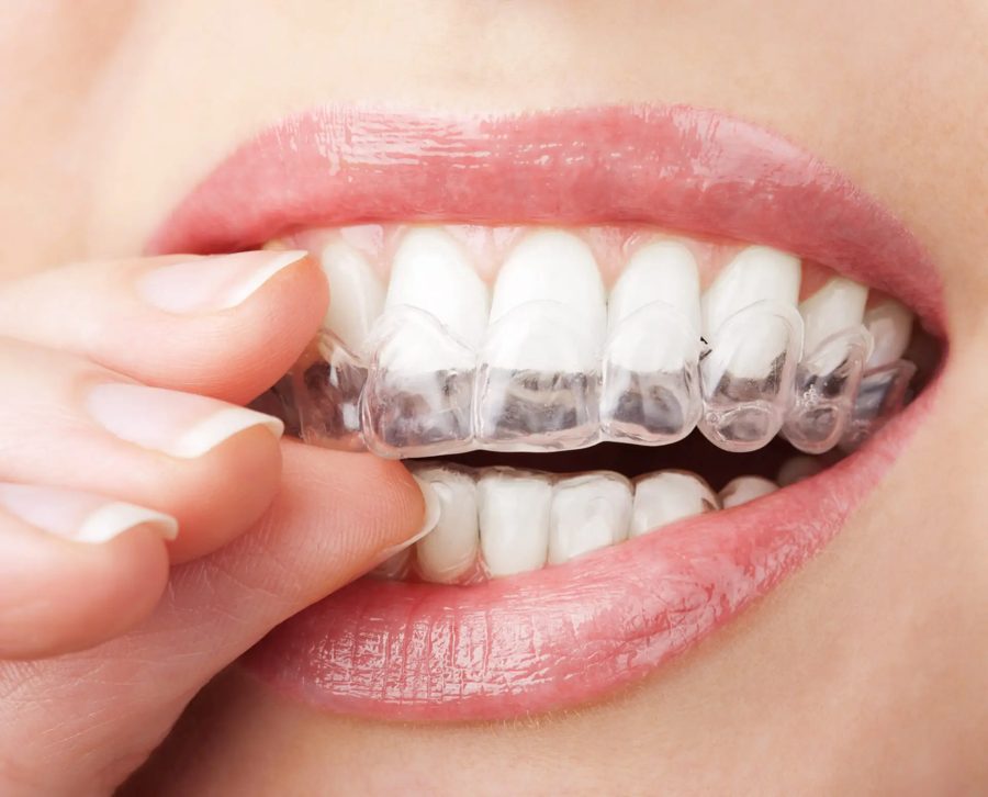 Gouttière Invisalign transparente sur les dents